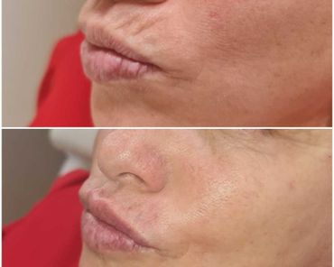labios antes y despues de tratamiento